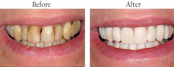 South Philadelphia Before and After Teeth Whitening